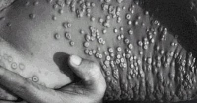 世界十大传染病排名 史上公认的最厉害严重的十大传染病