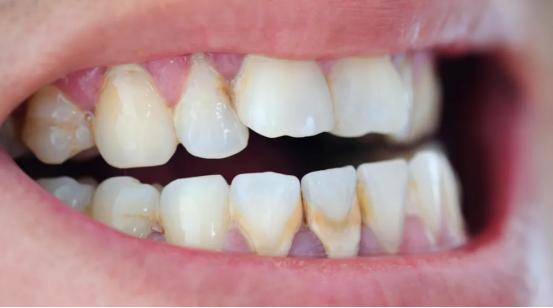 牙结石0度到3度的图