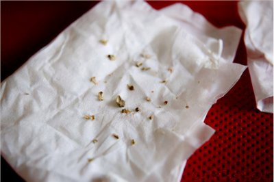 牙结石0度到3度的图 如何判断自己有没有牙结石