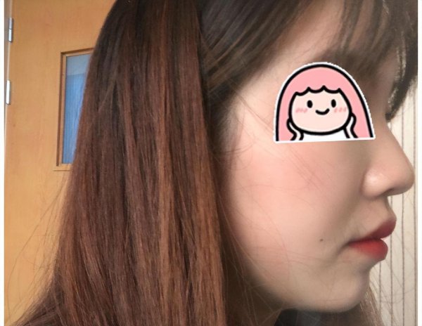 面部做什么动作可以消除法令纹