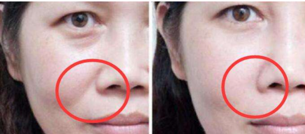 面部做什么动作可以消除法令纹