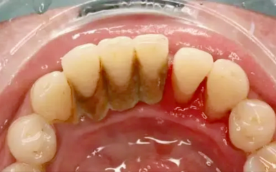 为什么人都后悔洗牙 哪些患者是不适合进行洗牙的