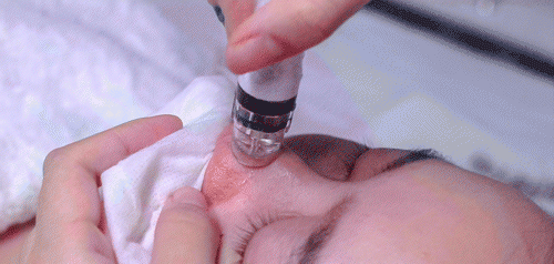 小气泡会让毛孔变大吗