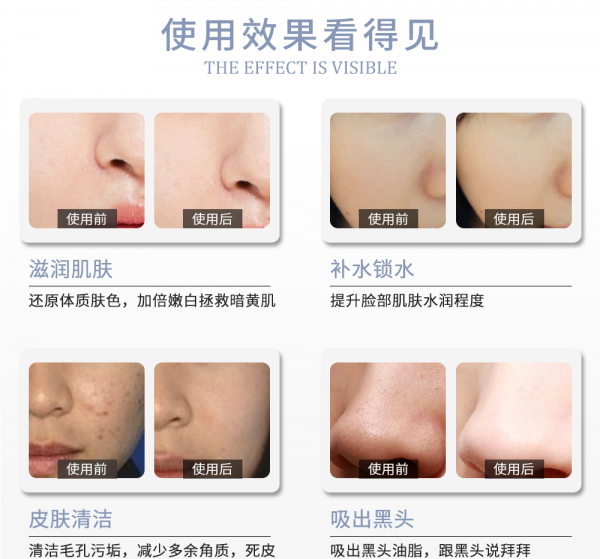 小气泡会让毛孔变大吗