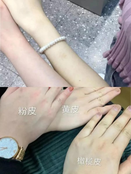 橄榄皮算是白皮还是黄皮