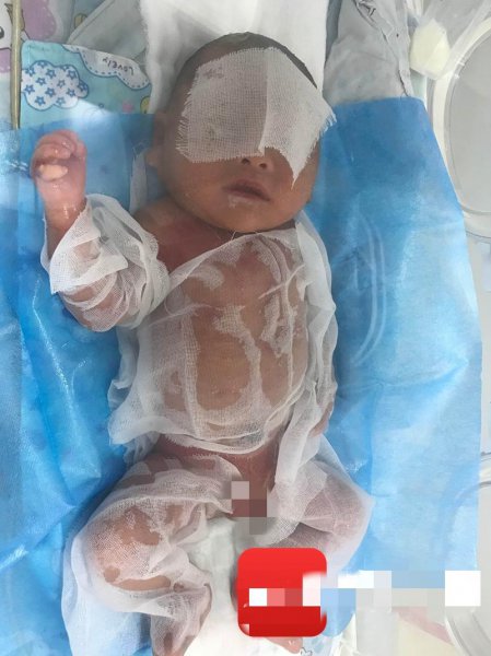 火棉胶婴儿是什么样子的