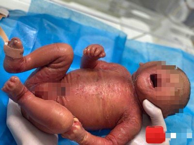 火棉胶婴儿是什么样子的 出现火棉胶婴儿到底是怎么回事