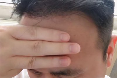 眉毛到发际线几根手指正常 女生正常发际线在哪个位置