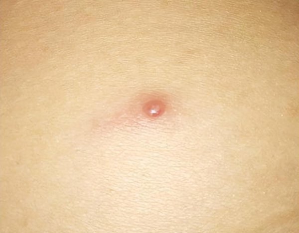 爱被蚊子咬是什么体质