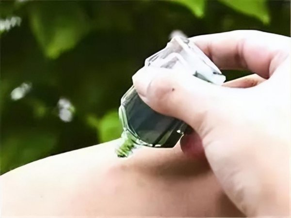 爱被蚊子咬是什么体质