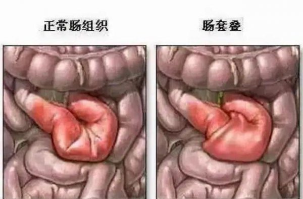 大肠包小肠是什么意思