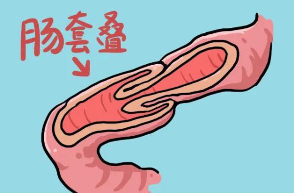 大肠包小肠是什么意思