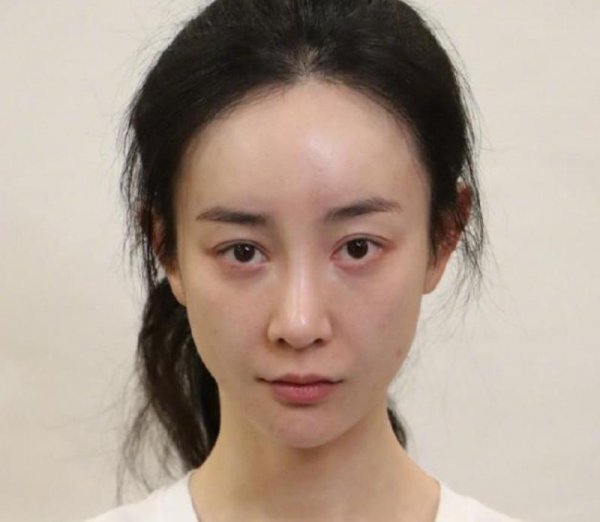 张檬为什么要整容