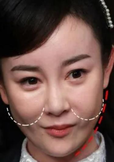 张檬为什么要整容