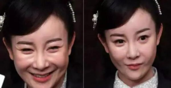 张檬为什么要整容