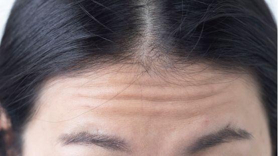 抬头纹太深了用什么方法能去掉