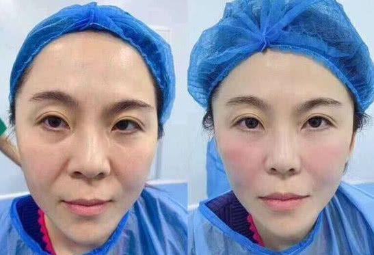 纹唇和涂口红哪个伤害大