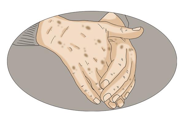 老人斑只有老人会长吗