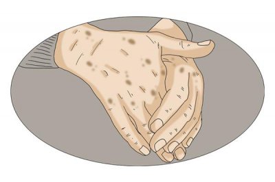 老人斑只有老人会长吗 上了年纪的人为什么会长老年斑