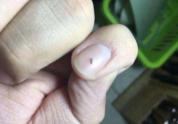 虱子的由来这是怎么长出来的