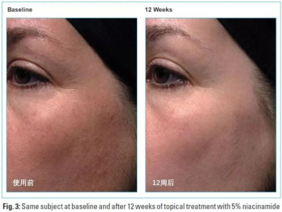 为什么用了烟酰胺越来越黑 用烟酰胺脸上的斑为什么更明显