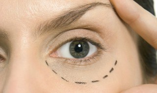 眼睛下面皱纹怎么去除 眼睛下面皱纹如何去除