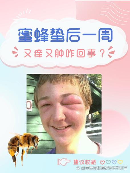 土蜂蛰了最佳处理方法（土蜂蜇伤五步处理与日常防护要点）