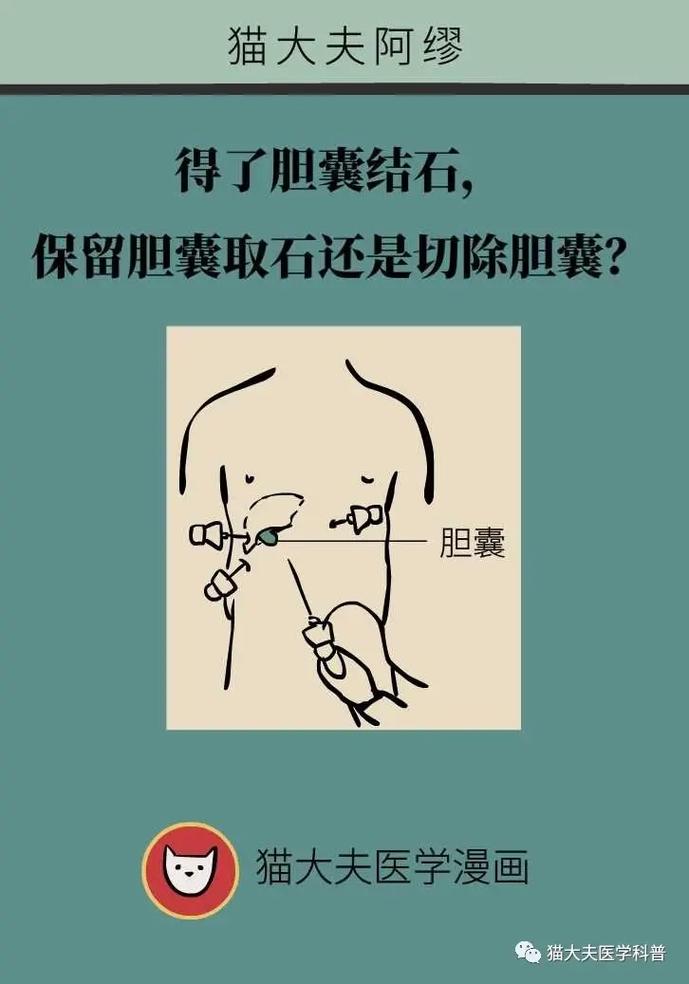 泥沙型胆囊结石最佳处理方法（药物ERCP胆囊切除及日常防复发）